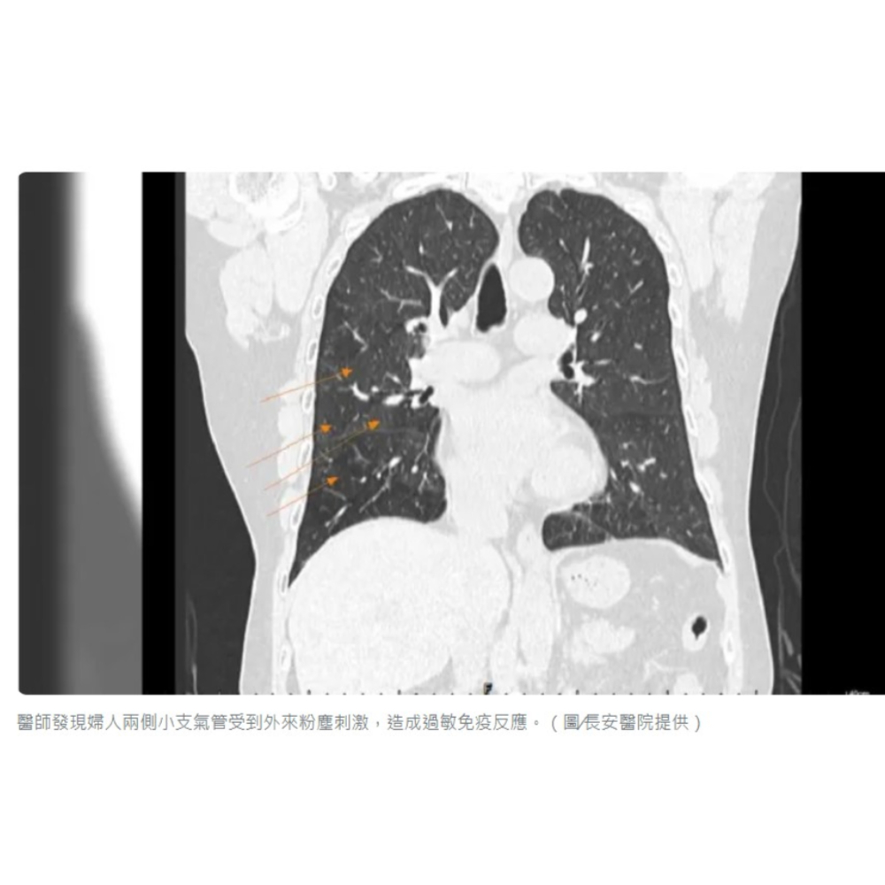 dctpro article img A woman was diagnosed with Flour Bag Lung after prolonged exposure to flour while wrapping chicken nuggets for deep-frying.